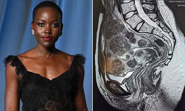 Lupita Nyong’o Fights Back After ‘Suffering In Silence’ From 77 Uterine Fibroids