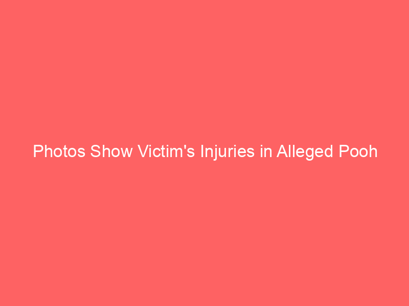 Photos Show Victim’s Injuries in Alleged Pooh Shiesty Robbery